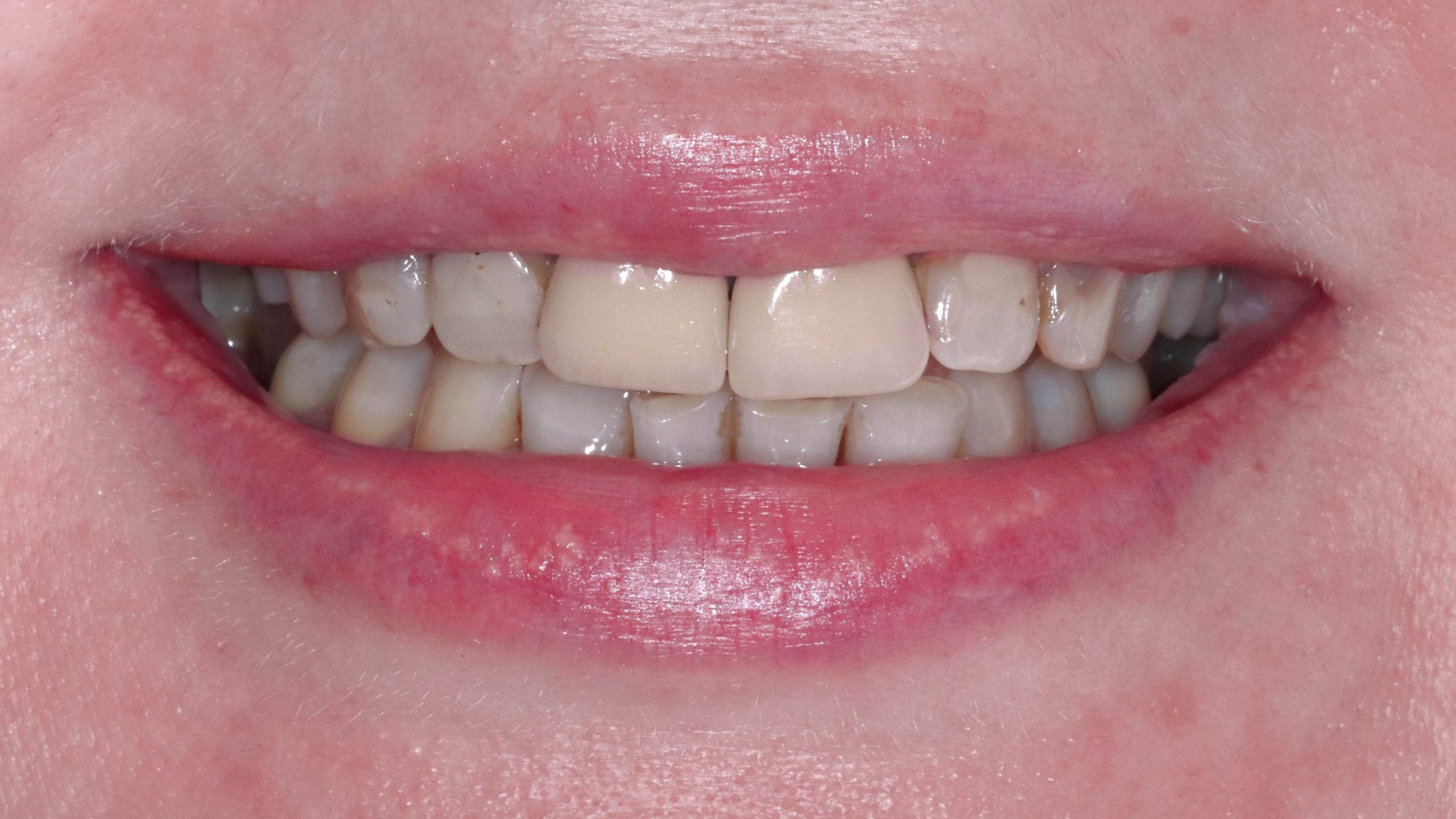 bleaching-veneers-munich-patient-showcase-before-after-treatment-result-initual-situation